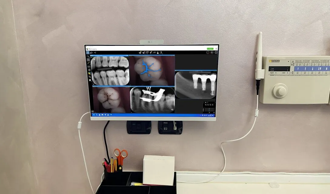 L’Implantologia Dentale: Dalla Pianificazione Digitale al Sorriso Perfetto